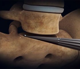 Транспедикулярный межтеловой спондилодез в комплексном лечении проникающих и оскольчатых переломов поясничного отдела позвоночника