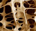 Лікування остеопорозу у контексті профілактики переломів: впровадження даних доказової медицини в клінічну практику. У ракурсі — ібандронова кислота  