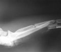 Лучевая терапия в практике металлополимерного эндопротезирования длинных костей
