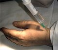 Общие принципы лечения стенозирующих лигаментитов пальцев кисти