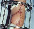 Використання вільної та невільної пересадки m. Latissimus dorsi хворим з ішемічною контрактурою фолькмана верхньої кінцівки тяжкого ступеня